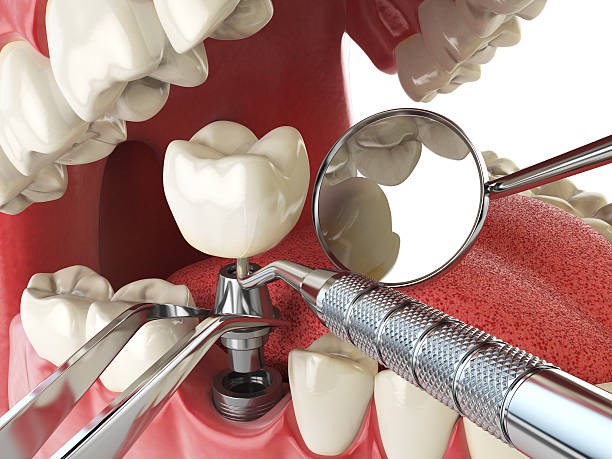 Best Emergency Treatment for Dental Infections or Abscesses in Rifle, CO